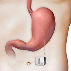 Dispositivo semelhante a marcapasso instalado no estômago promete combater o refluxo (Reprodução de Internet)