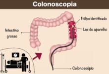 colonoscopia-exame-indicado-para-identificar-cancer-colorretal