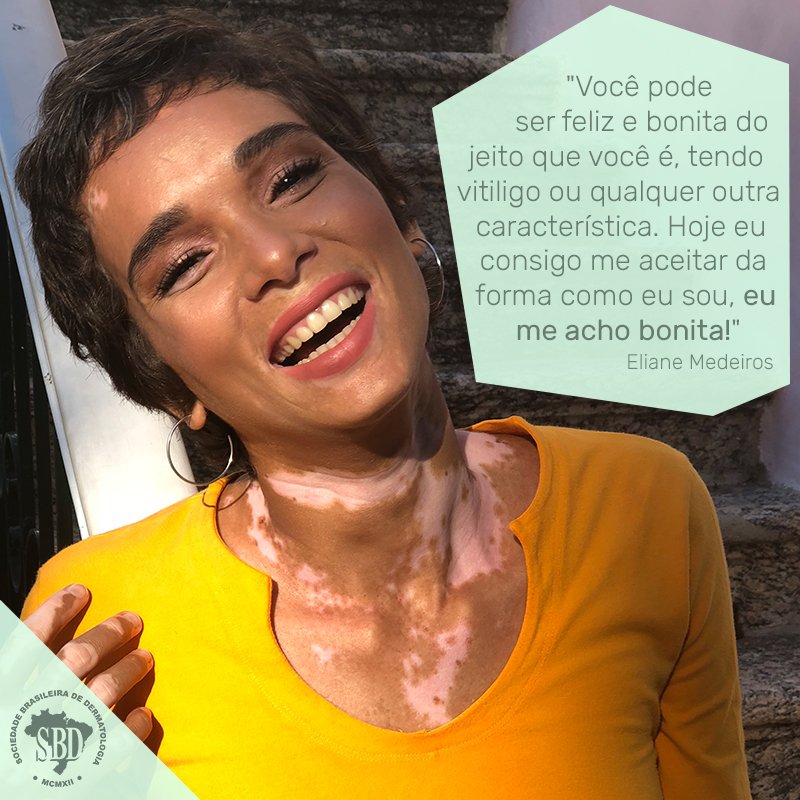 Eliane, modelo com vitiligo